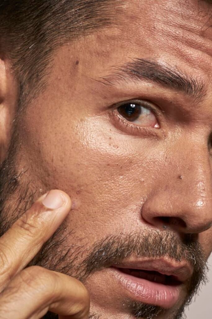 Men's Acne & Pore Control